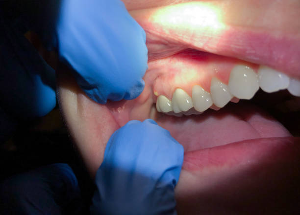 Best Tooth Infection Emergency Dentist  in Parma Heights, OH